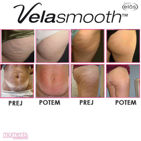 PAKET 6x ANTICELULIT VELASHAPE-4