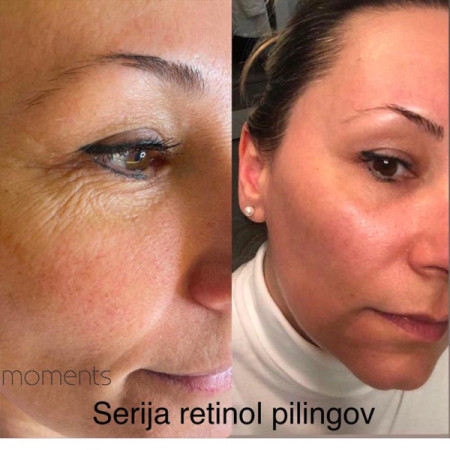 RETINOL PILING SKIN REVIVAL-3