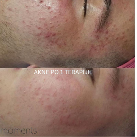 RETINOL PILING ACNE-4