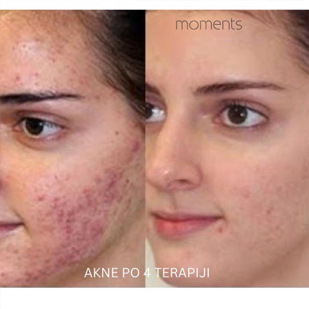 RETINOL PILING ACNE-3