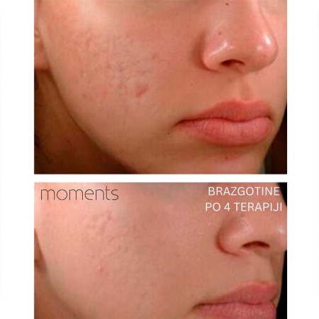 RETINOL PILING ACNE-2