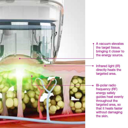 Anti celulit VelaShape3 Anti celulit VelaShape3