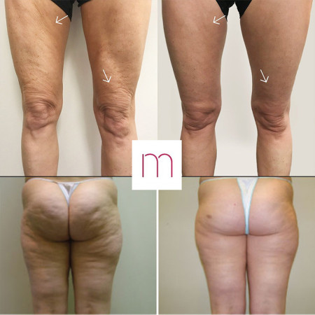 PAKET 3x ANTICELULIT VELASHAPE