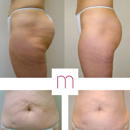PAKET 3x ANTICELULIT VELASHAPE